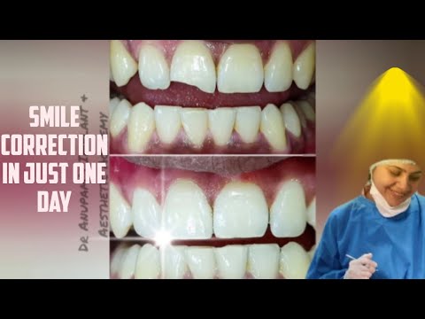 Smile correction in just one day! #cosmeticdentistry #dentist #dental #smilecorrection