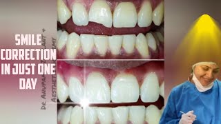 Smile correction in just one day! #cosmeticdentistry #dentist #dental #smilecorrection