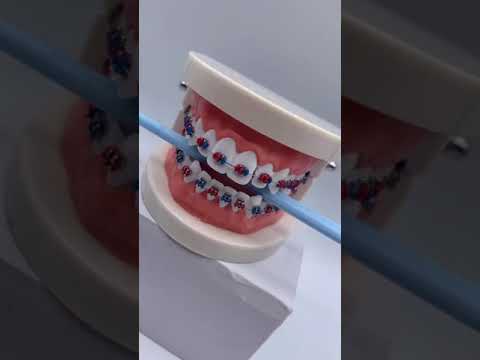 Choose your #braces journey #shorts
