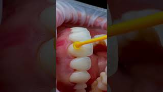 #dentistry #dentistryworld #dentist #dentalstudents #dentaleducation #work #dubai #veneers