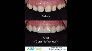 Smile Transformation and Teeth Gap Closure with Ceramic Veneers#smilecorrection#perfectsmile