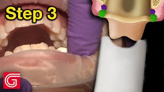 Creating #Dental Provisional from a Digital Scan #shorts