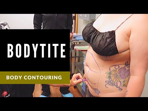 BodyTite by InMode at Young Medical Spa®