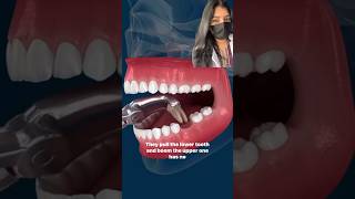 “This Is What REALLY Happens During a #ToothExtraction 🦷😳 #DentistExplains #Shorts”