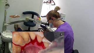Teeth cleaning / removal tartar / scaling / dental hygienist