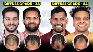 Hair Transplant in Vijayawada | Best Results & Cost of Hair Transplant in Vijayawada