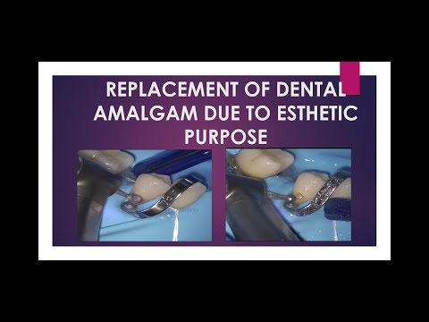 Replacement of dental Amalgam restoration for esthetic purpose ♠️😉