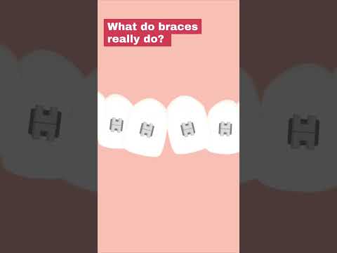 Are Braces Really That Scary? Discover the Truth at Smiles Royale! 🦷✨