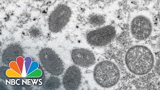 Number Of Monkeypox Patients Are Gay And Bi-Sexual Men