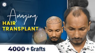 Massive Hair Transplant | 4000 Grafts | Grade 5 Baldness | Bangladesh