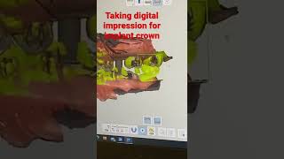 Digital Impression for Implant Crown