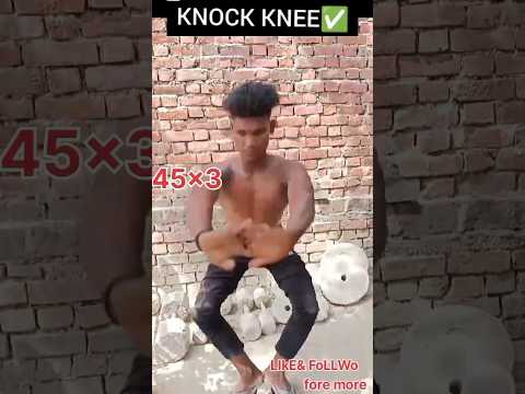 KNOCK  KNEE ✅#youtubeshorts#video #shorts  #funny