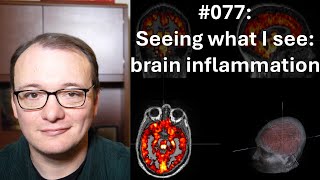 077 - Seeing what I see: brain inflammation