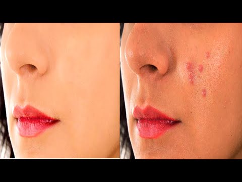 how to remove pimples marks easily