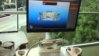ITERO Digital Impression Scanner at Fey & Grey Orthodontics: Part II