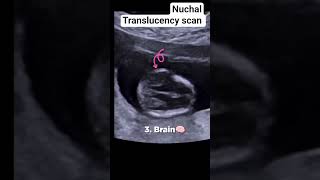 Nuchal translucency scan #radiology #ultrasound #pregnant #pregnancyscan #baby