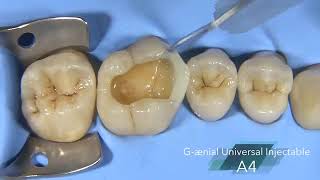 GC: Cusp build up of a molar with G ænial Universal Injectable