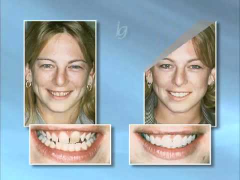 The Smile Dr. - Before and After