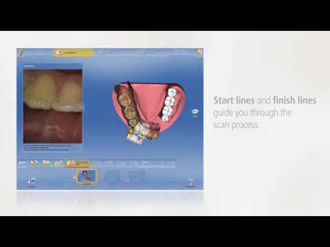CEREC OMNIcam Ortho scanning