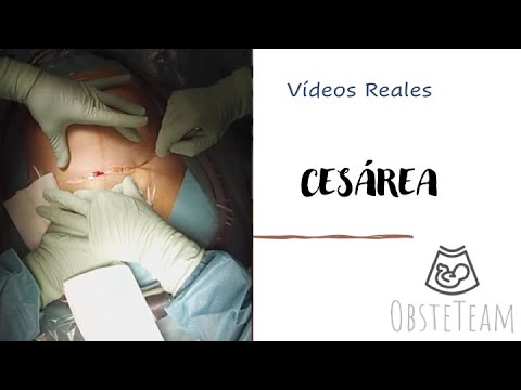 CESÁREA REAL / OBSTETEAM