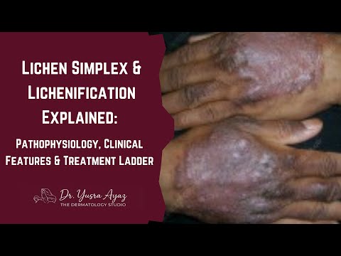 Lecture 6: Lichen Simplex & Lichenification: Pathophysiology, Clinical Features & Treatment Ladder