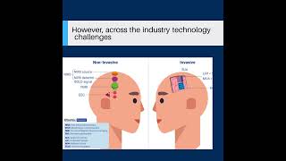 60 Second Insights: The Brain Computer Interface Market
