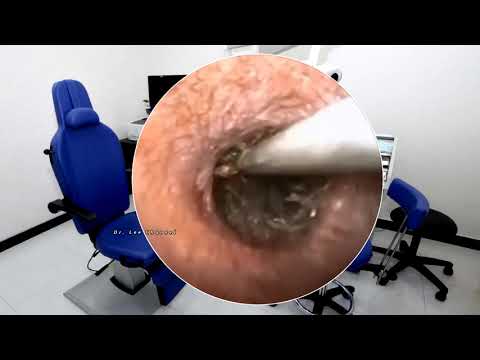 Top 2 GIANT EARWAX removing