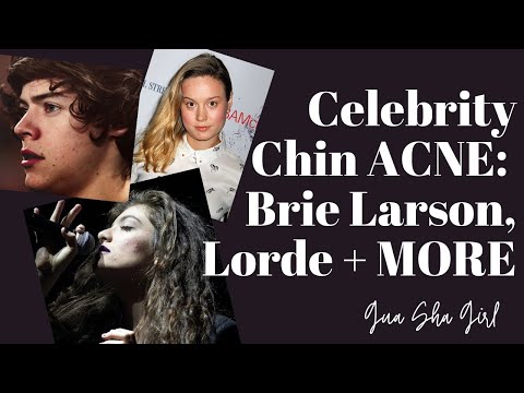 Celebrity Chin Acne: Brie Larson, Lorde and MORE! How To Treat Acne According To Face Mapping