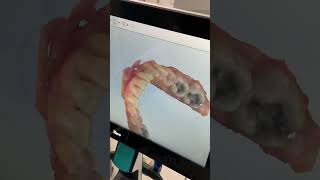 What an Invisalign Digital Scan Can Do For You, And Why You Shouldn’t Do Invisalign Without It