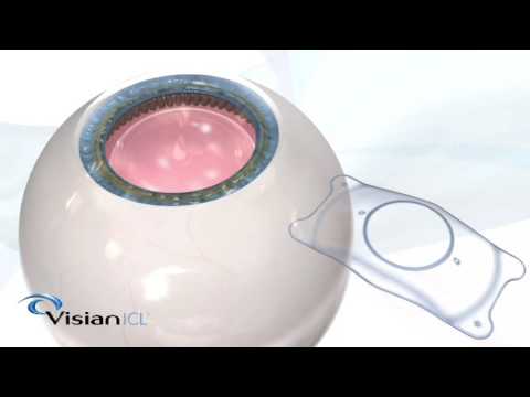 Visian ICL