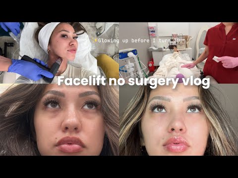 I got a FACELIFT without plastic surgery… My experience + post op vlog