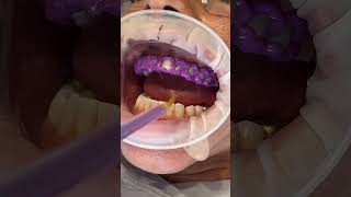 Biomimetic Esthetic Dentistry - Veneers PART I #biomimeticdentistry #veneers #estheticdentistry