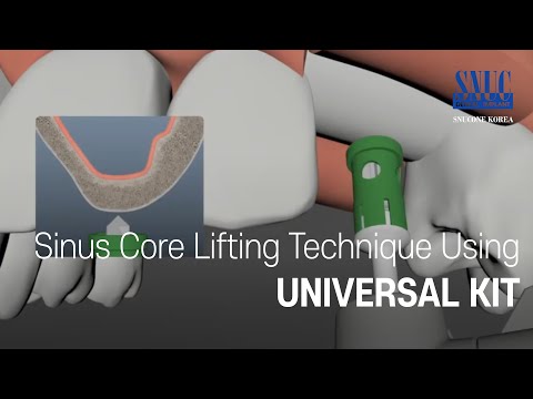 Sinus Core Lifting Technique Using Universal Kit