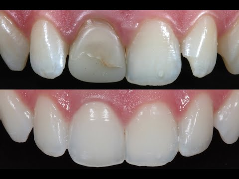 Better/brighter smile