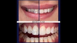 Bioclear - The Best Alternative to Veneers and Bonding - Patient Testimonial