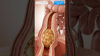 Colon Animation of Compacted Stool Mass Bursting Under Peristaltic Pressure #guthealth #shorts