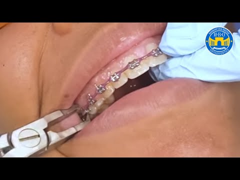 Braces Removal and Retainers on the SAME DAY
