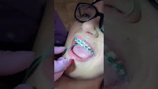 How to Floss With Braces