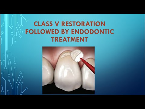 Class V restoration followed by endodontic treatment ✌️