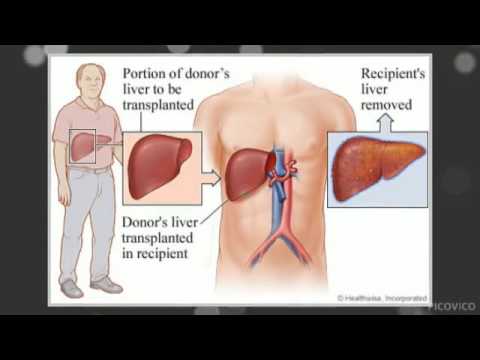 Liver Transplant in Delhi | Liver Transplant India