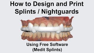 How to Design and Print Splints/Nightguards Using Free Software (Medit Splints)