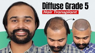 Hair Transplant in Jodhpur | Best Results & Cost of Hair Transplant in Jodhpur