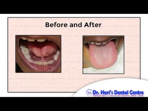 Tongue Tie Correction | Laser surgical procedure | Dr. Hari's Dental Centre | Medavakkam | Chennai