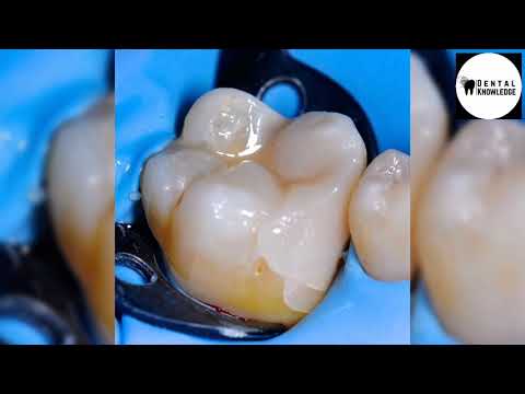 Direct restoration 🦷