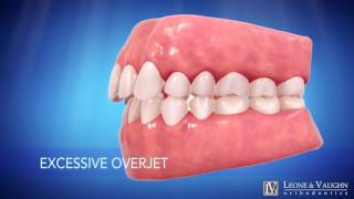 Smile Enhancement With Invisalign @ Leone & Vaughn Orthodontics!