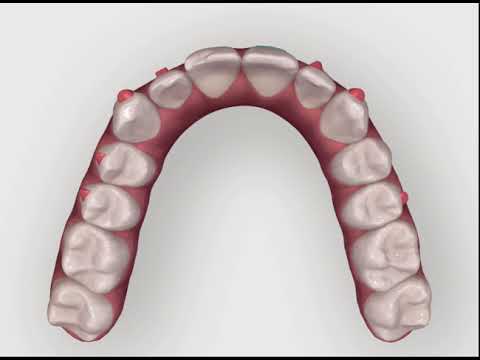 Invisalign Tooth Movement - JB White DDS Las Vegas
