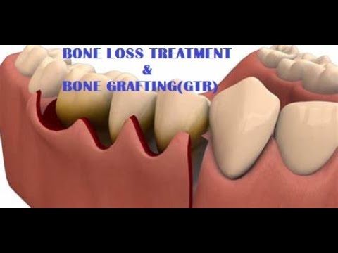 Gum graft(GTR) Periodontal Flap surgery & bone graft for treating loose tooth. মাড়ির শল্য চিকিৎসা।