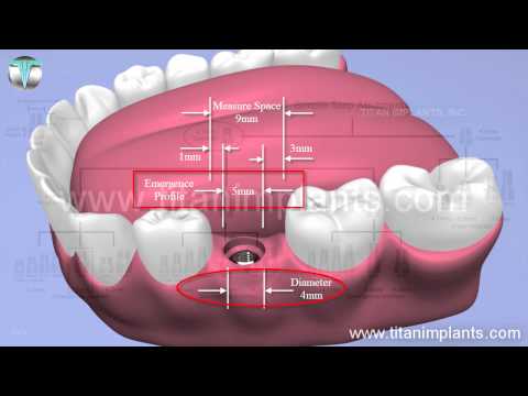 Open Tray Impression Technique Using Simple Step Abutments