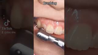 TEETH CLEANING PROCEDURE