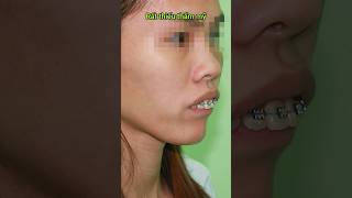 Buck teeth braces #braces #orthodontist #dental #dentistry #niengrang